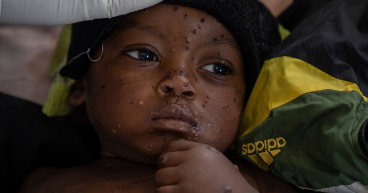 1st mpox vaccine for children approved by WHO – National | Globalnews.ca