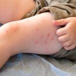 Soaring number of Alberta measles cases worries health officials in both Canada, U.S.  | Globalnews.ca