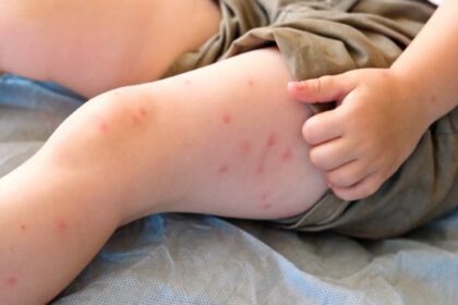 Soaring number of Alberta measles cases worries health officials in both Canada, U.S.  | Globalnews.ca