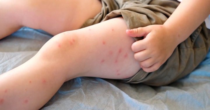 Soaring number of Alberta measles cases worries health officials in both Canada, U.S.  | Globalnews.ca